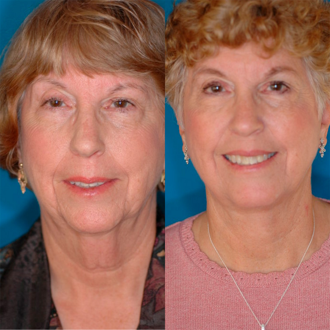 Ultimate Alpha Stack