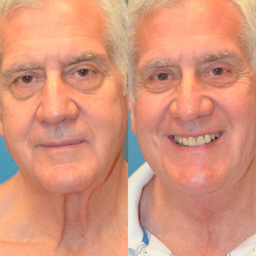 Ultimate Alpha Stack