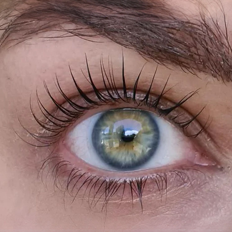 Lily after dermatica anti-ageing treatment