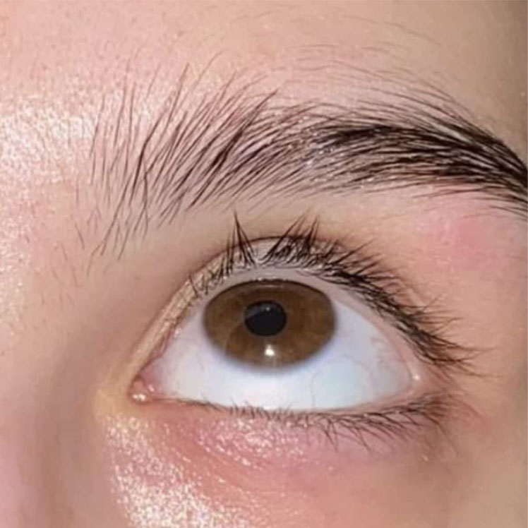 Lily before dermatica anti-ageing treatment
