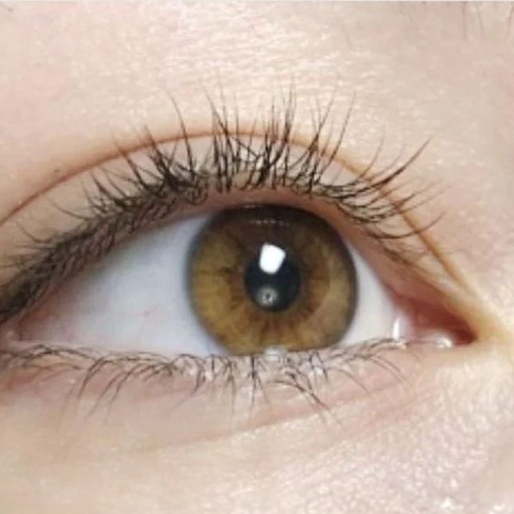 Lily before dermatica anti-ageing treatment