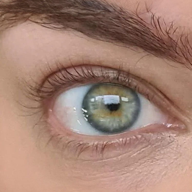 Lily before dermatica anti-ageing treatment